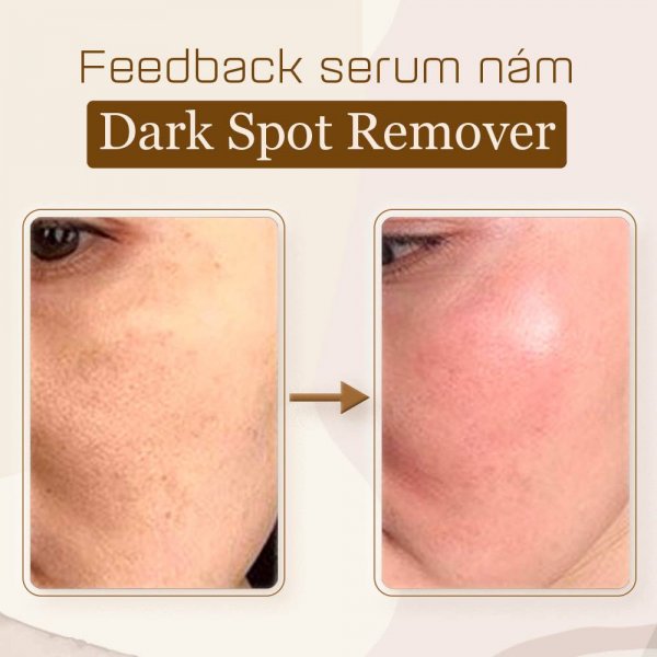 Serum giảm thâm Nám KimKul Dark Spot Remover 30ML - Serum huyết thanh hỗ trợ xóa Nám, phục hồi tổn thương da thâm, xạm, nám - Màu sắc Vàng , Đen Dung tích 30ml
